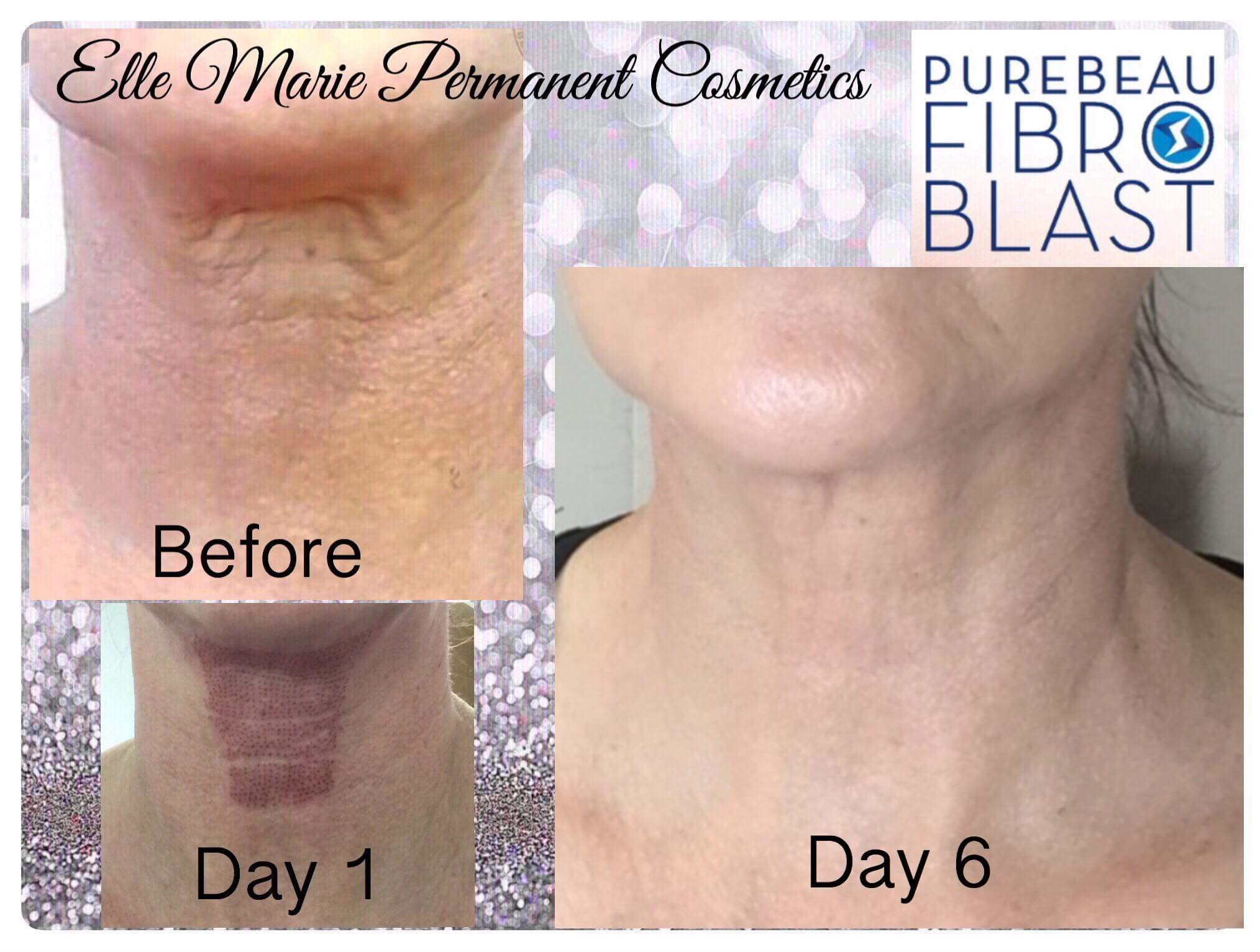 Purebeau Fibroblast Nonsurgical facelift in Leeds